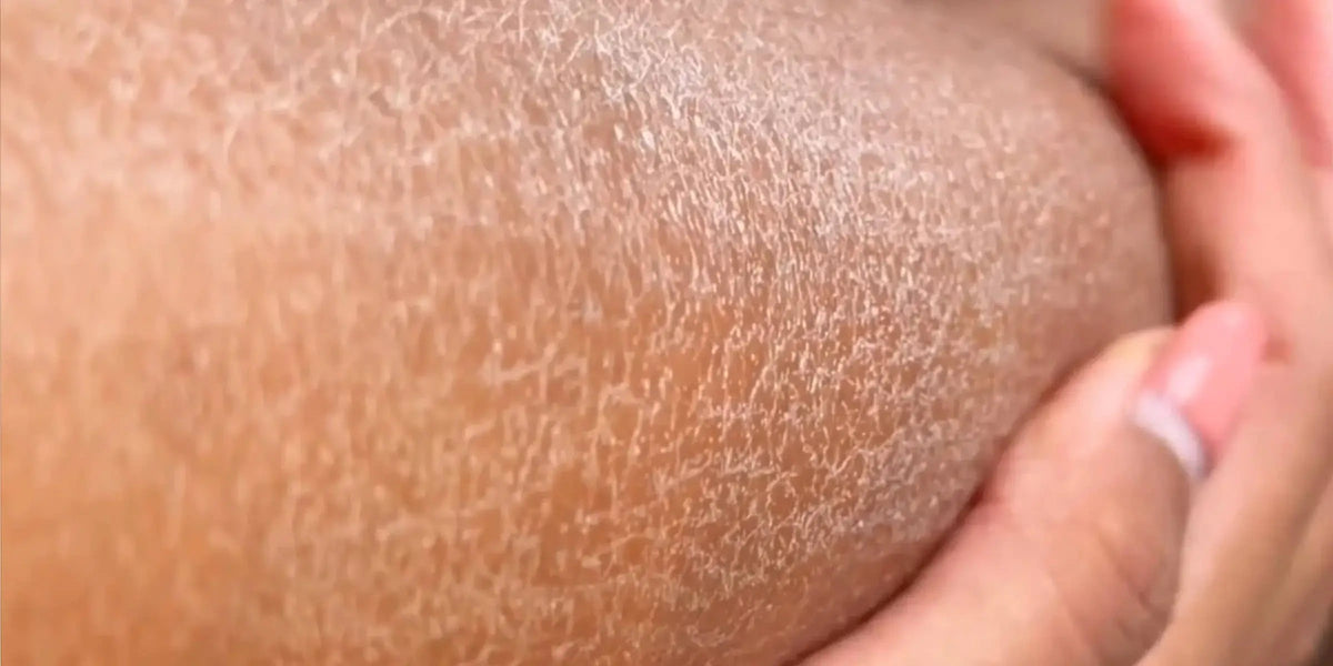 Pokožka pred používaním exfoliačného uteráka Kōji – suchá a matná